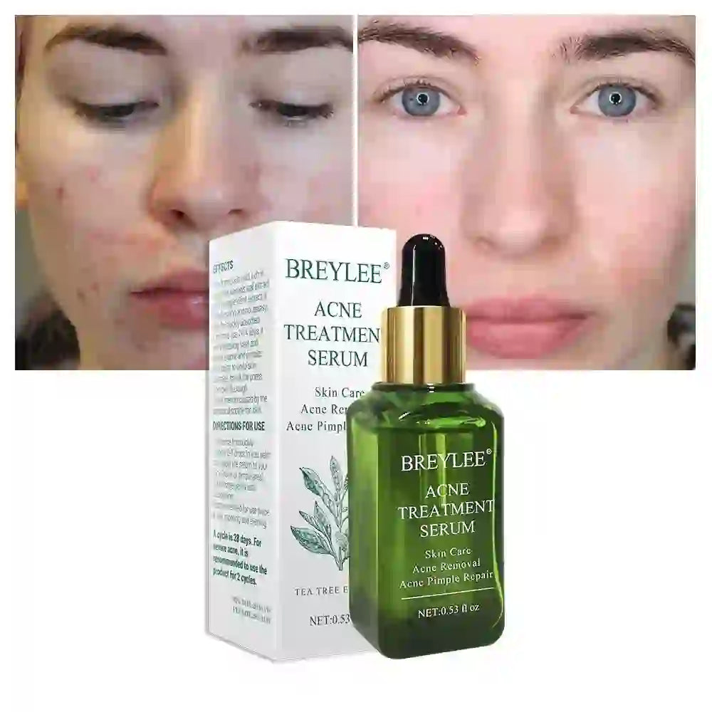 Acne Treatment Serum Face Facial Anti Acne Scar Removal