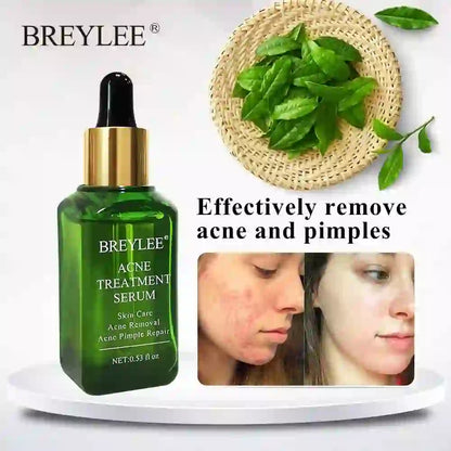 Acne Treatment Serum Face Facial Anti Acne Scar Removal