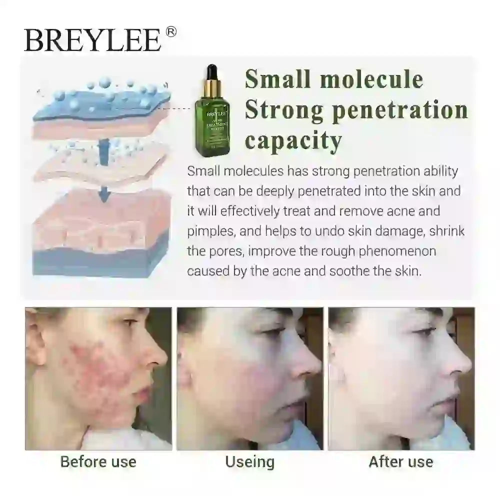Acne Treatment Serum Face Facial Anti Acne Scar Removal