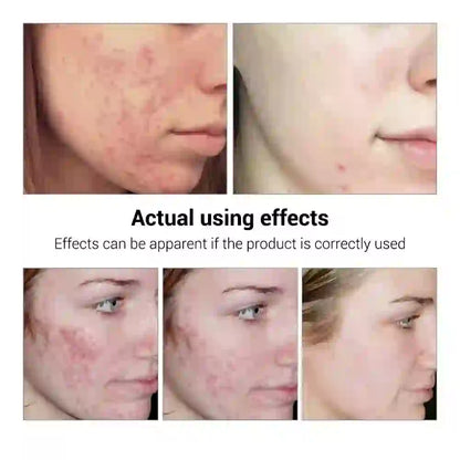 Acne Treatment Serum Face Facial Anti Acne Scar Removal